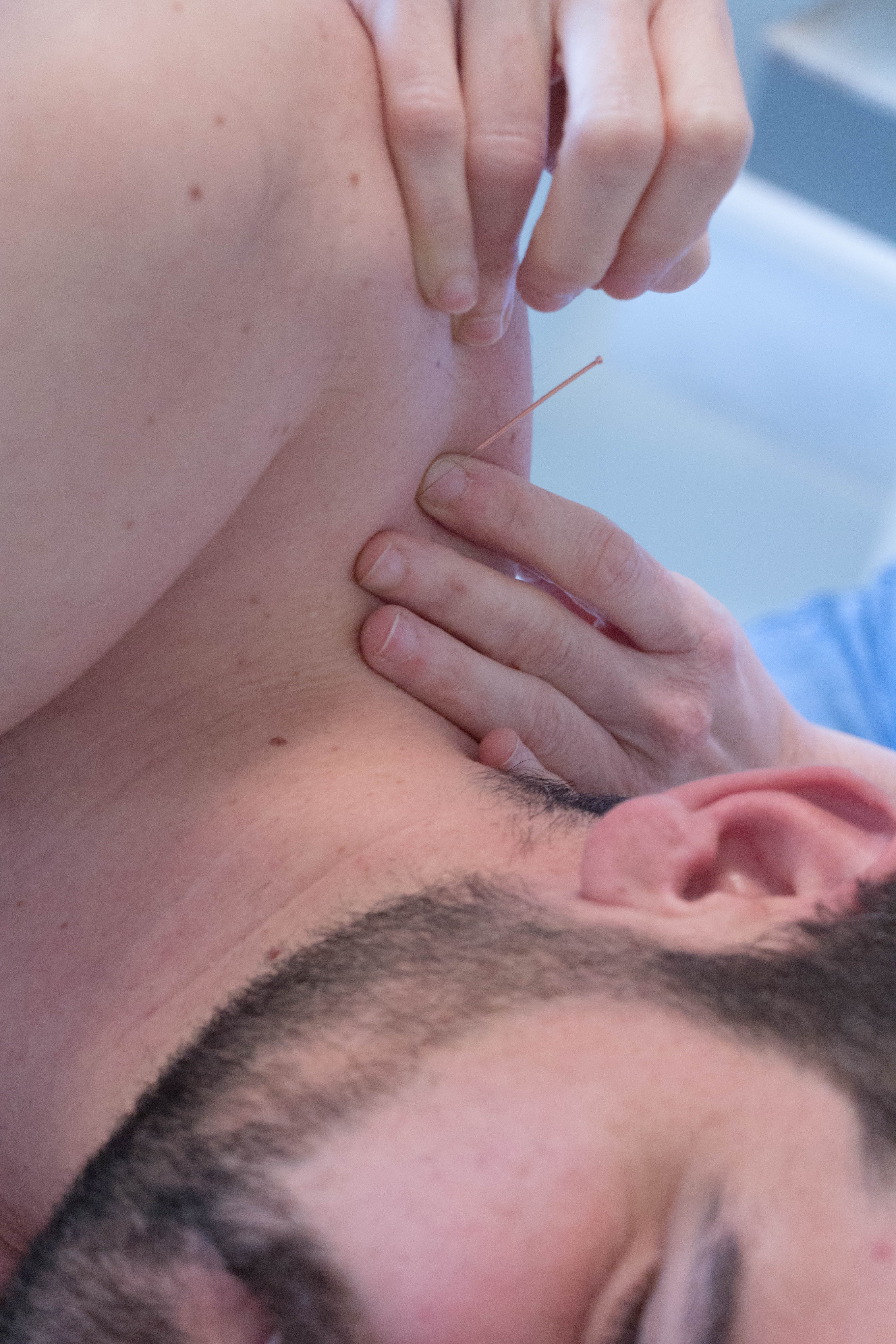 Dry needling